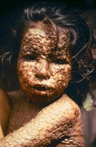 800px-child_with_smallpox_bangladesh