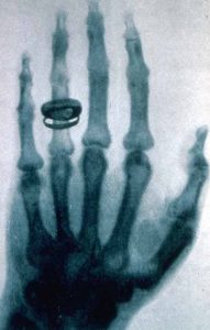 Una radiografia eseguita nel 1896 da Röntgen alla mano della moglie del fisiologo e anatomista Albert von Kölliker (credit: Pubblico Dominio)